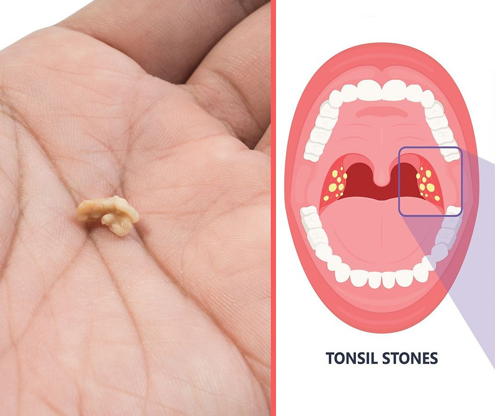 How to know if you have tonsil stones