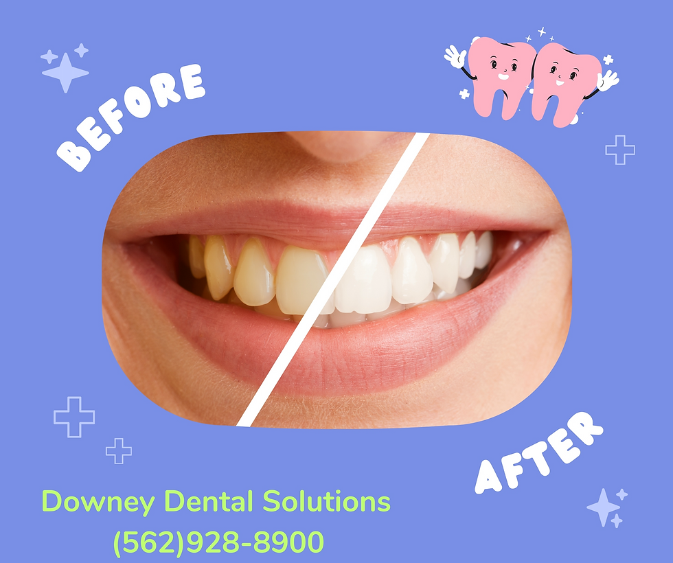 How long does it take to whiten teeth