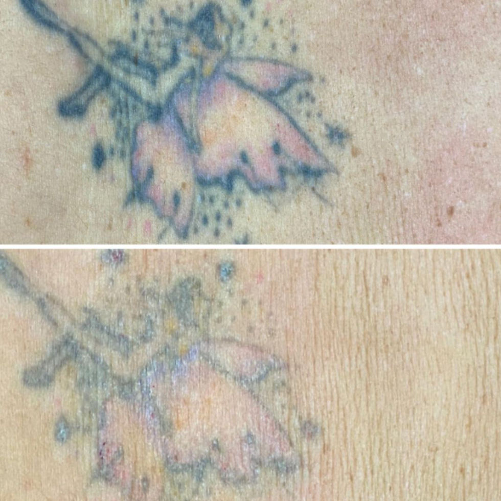How long does it take to remove a tattoo
