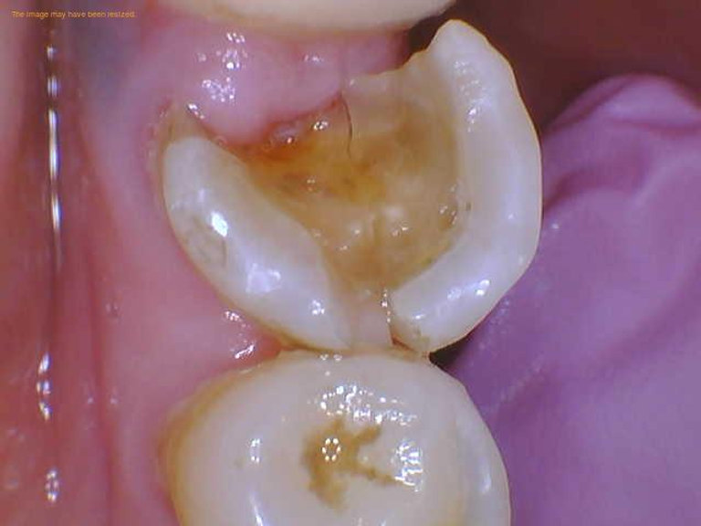 How to fix a split tooth
