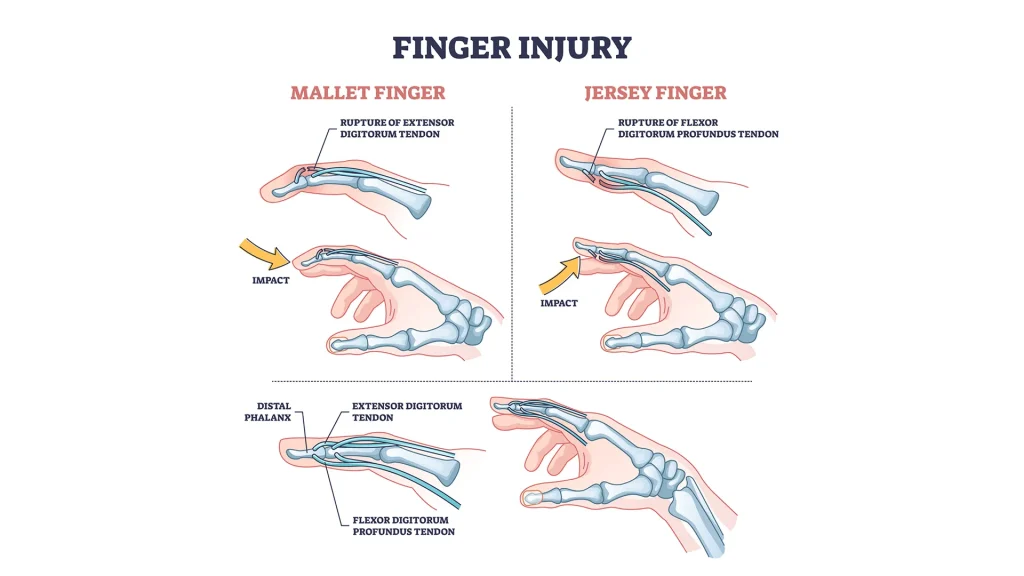 How to tell if finger is broken or sprained