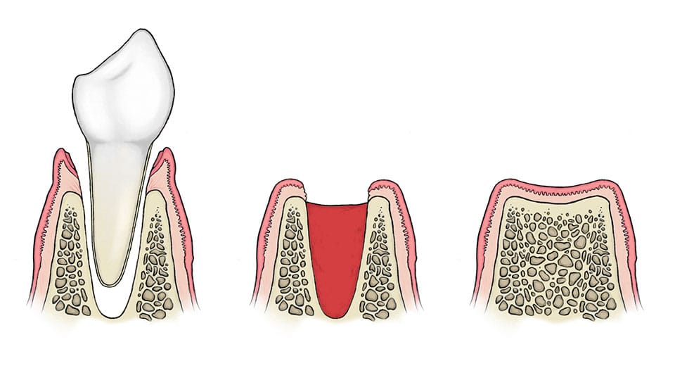 How long for wisdom teeth holes to close