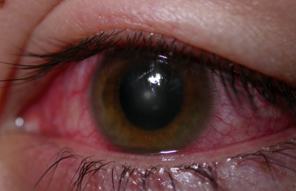 How to heal a scratched eye
