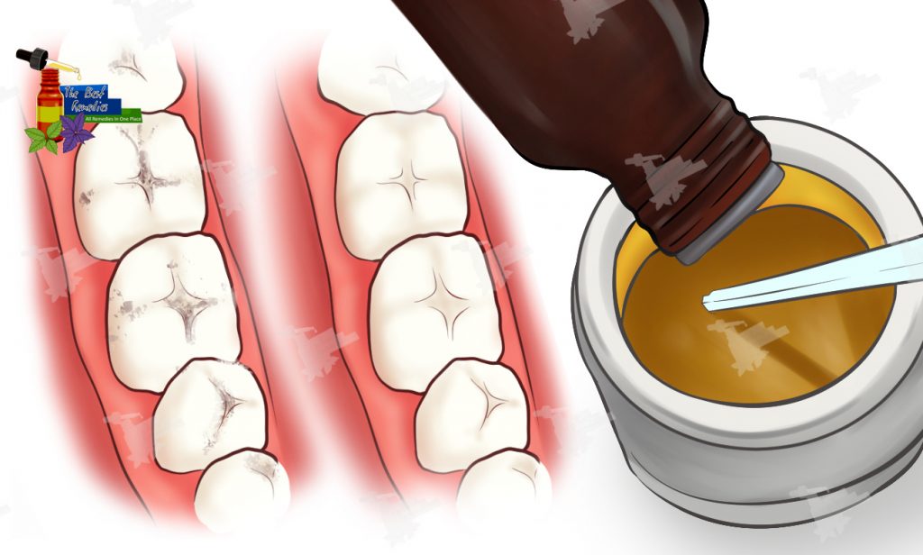 How to get rid of cavities naturally