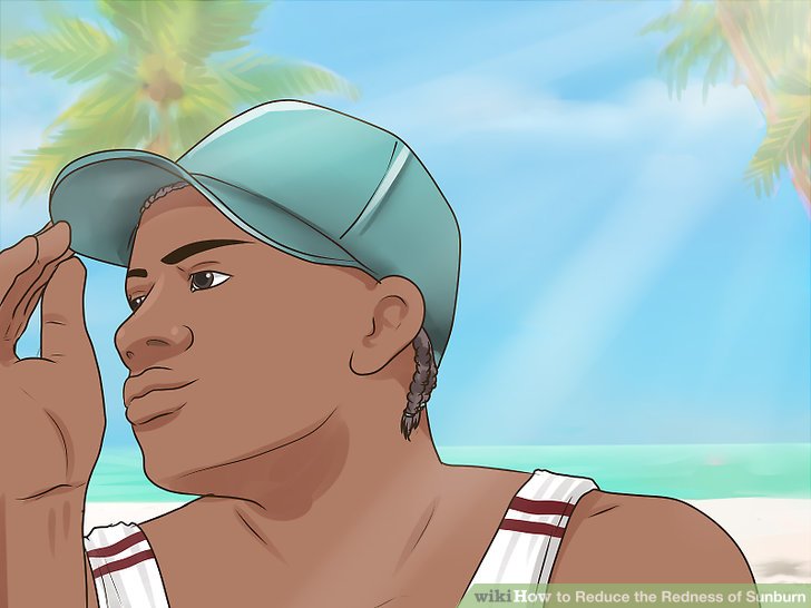 How to get rid of sunburn redness fast