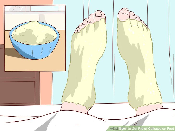 How to get calluses off feet