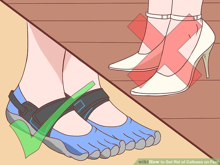 How to avoid feet callus