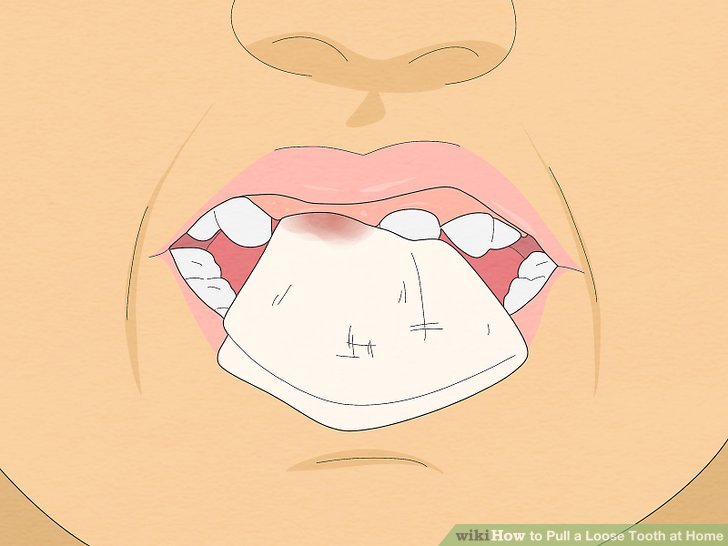 How to remove a tooth at home