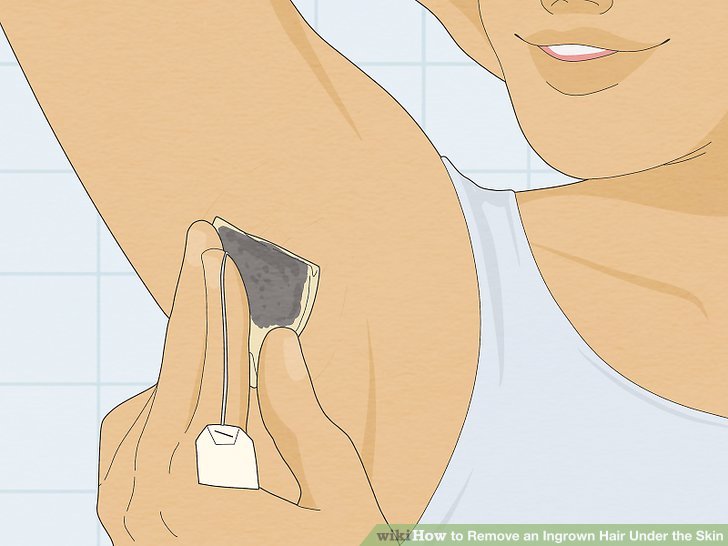 How to remove undergrowth hair