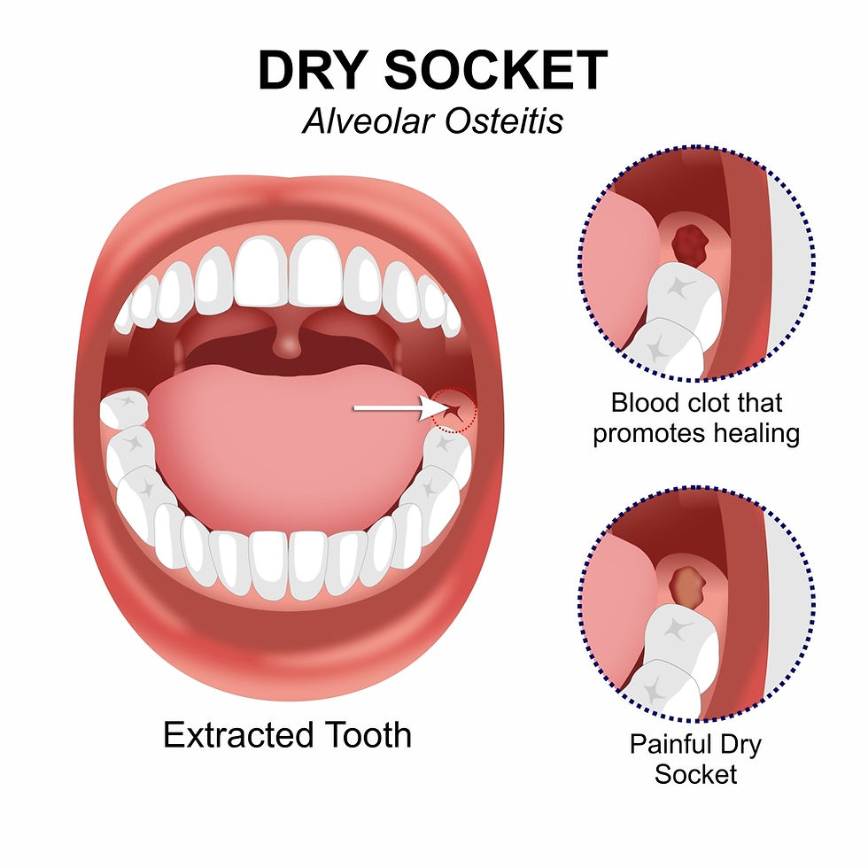 Dry socket how long does it take to heal