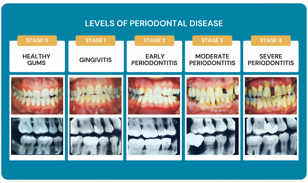 How to know if you have periodontitis