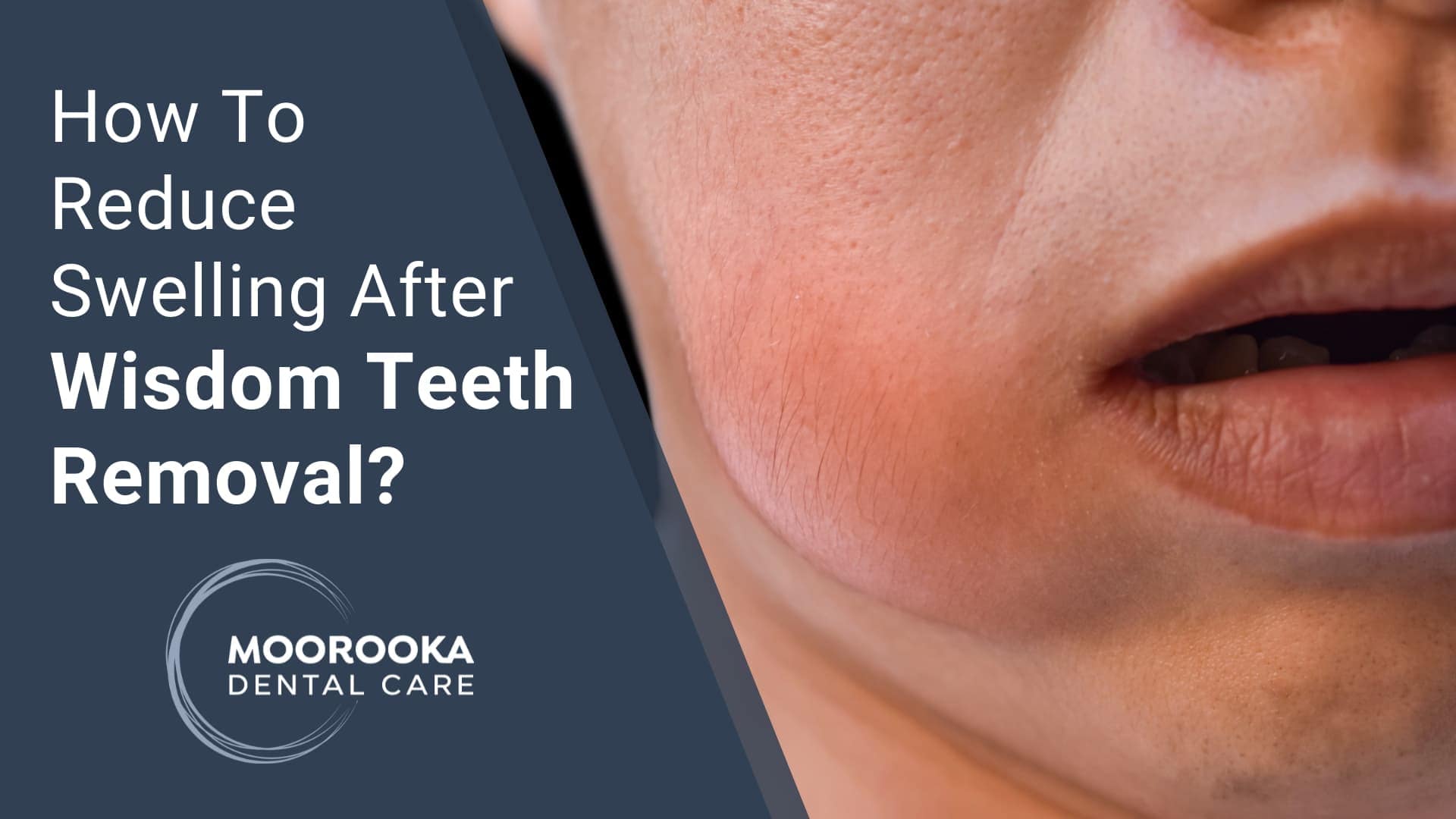 How to reduce swelling on wisdom teeth