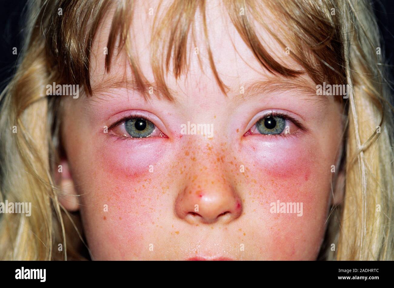 How to get rid of swelling around the eyes