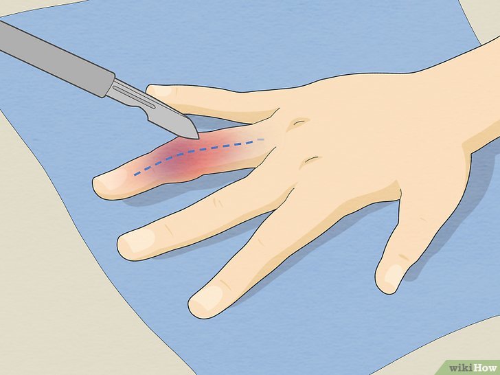 How to tell if you broke your finger